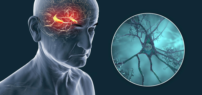 Alzheimer's Disease