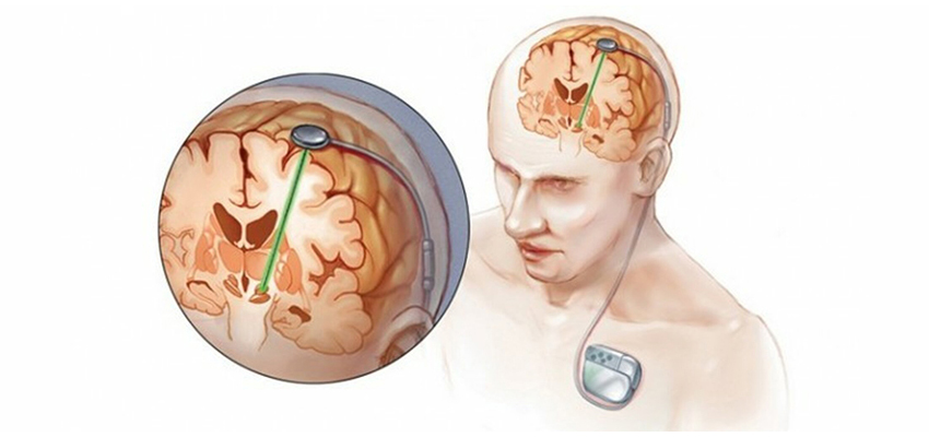 Deep Brain Stimulation Surgery