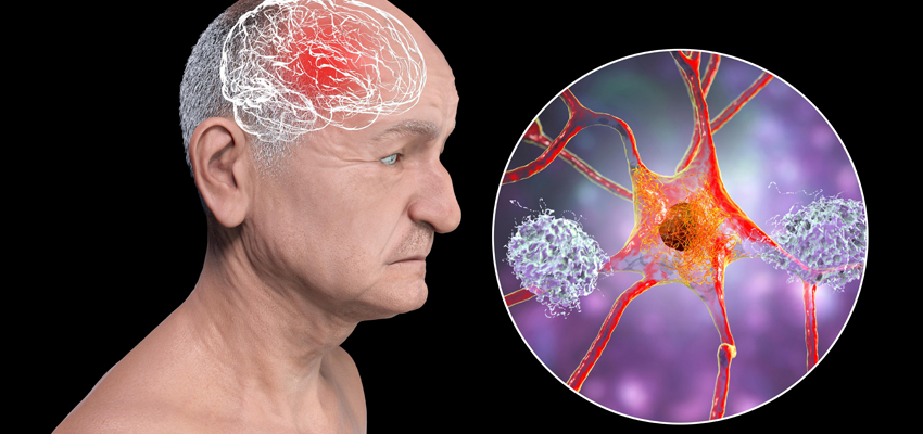 Parkinsonism
