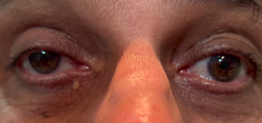 Progressive Supranuclear Palsy